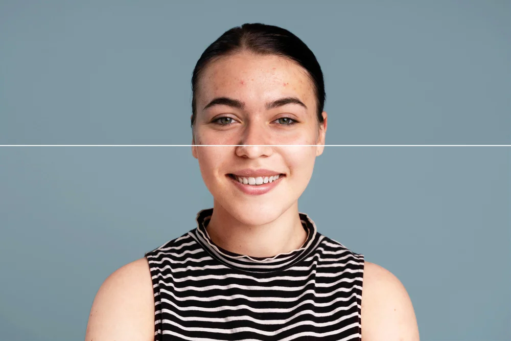 Akne Tedavisinde En Yeni Yöntemler Dermatoloji Dünyasındaki Gelişmeler.webp