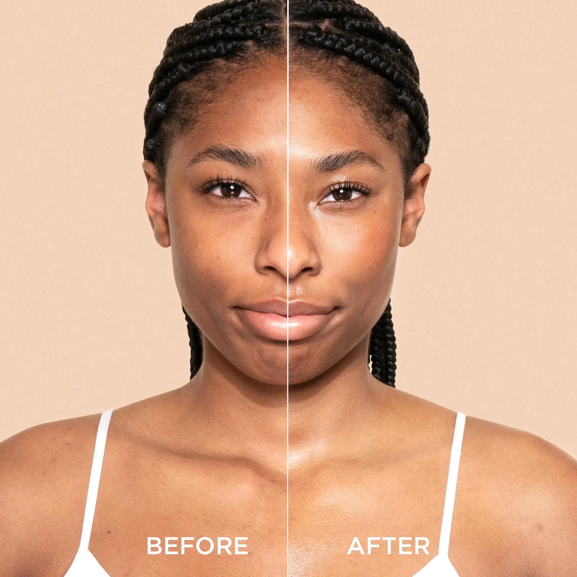 Akneli Ciltlerde Retinoid Kullanımı Dermatolojik Rehber ve Uyarılar.webp