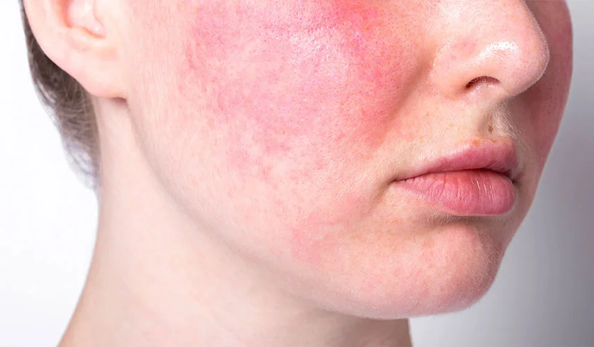 Ciltte Kızarıklık ve Tahriş Sorunu Alerji mi Rosacea mı Nasıl Anlaşılır.webp