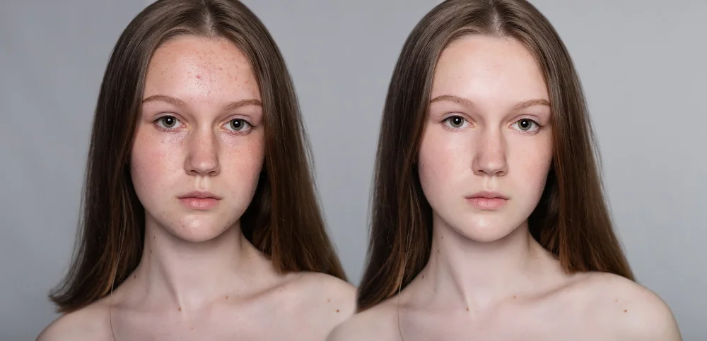 Dermapen ile Dermaroller Arasındaki Fark.webp