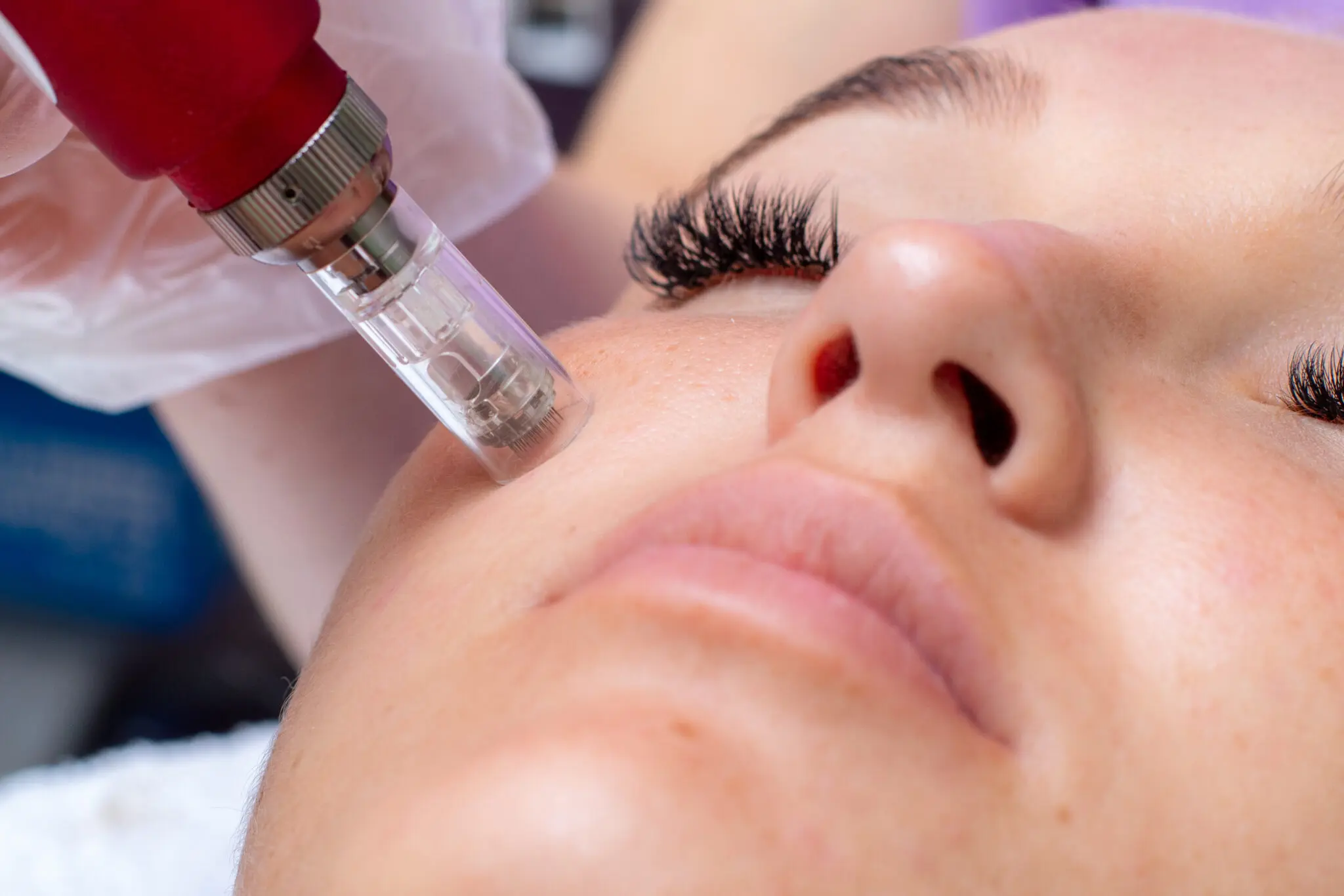 Dermapen Sonrası Kaşıntı ve Pullanma Neden Olur.webp
