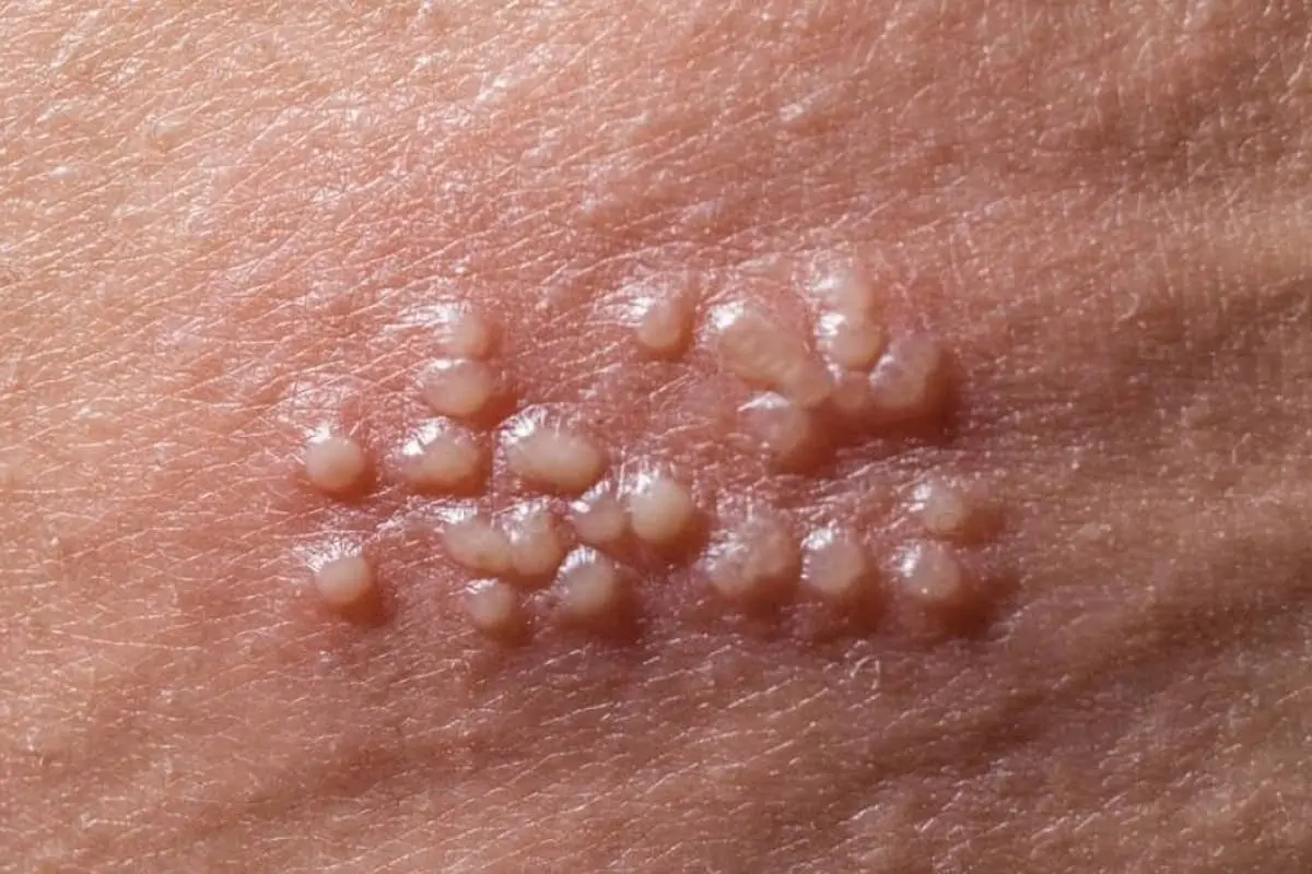 Genital Bölge Uçuğu.webp