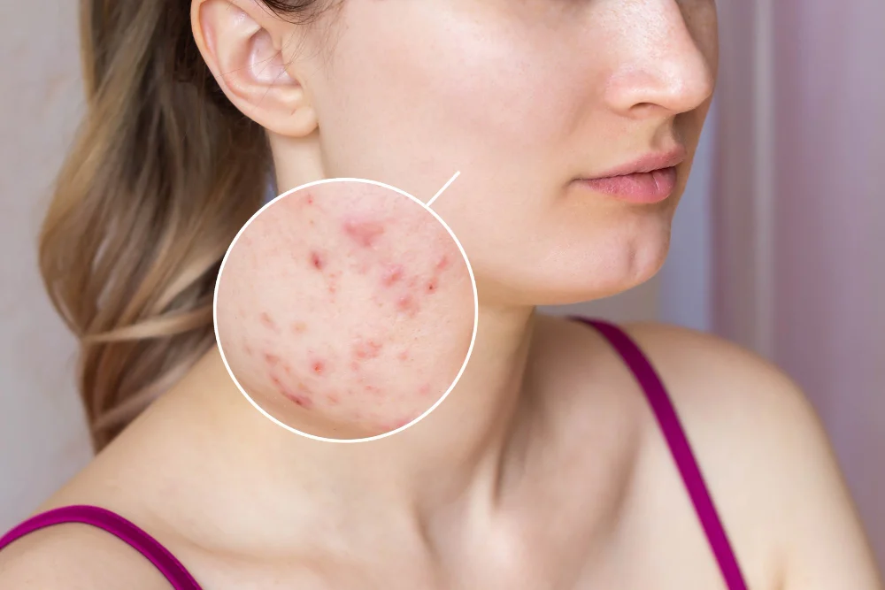 Roaccutane’ın Bilinmesi Gereken Yan Etkileri.webp