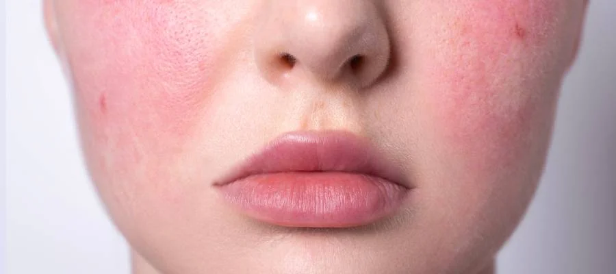 Rosacea’nın Sinsi Yüzü Gül Hastalığı Nedir, Nasıl Gelişir.webp
