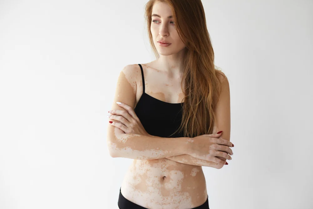 Sedef ve Vitiligo Hastalıklarında Dermatolojik Takip Neden Önemli.webp