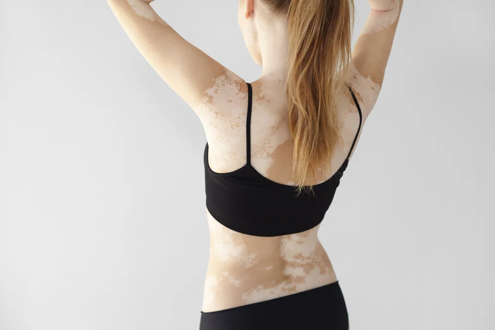 Sedef ve Vitiligo.webp