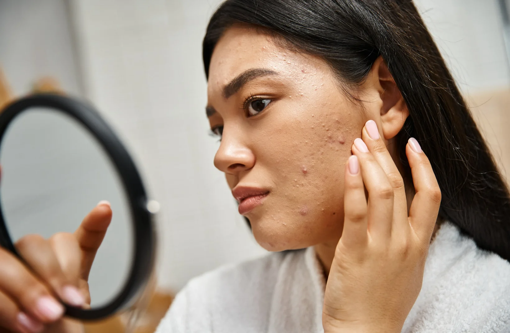 Sivilce İçin Dermatoloğa Ne Zaman Gidilmeli?.webp