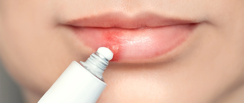 Eczanede Satılan En Etkili Uçuk Kremleri.webp