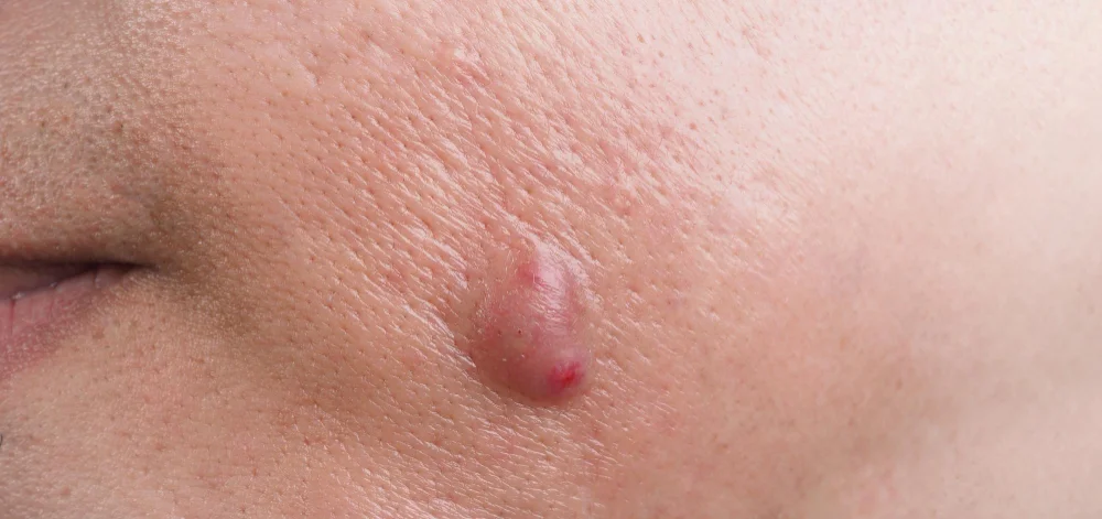 Fungal Akne Nedir.webp